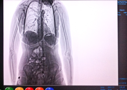 anne kling add xray nude photo