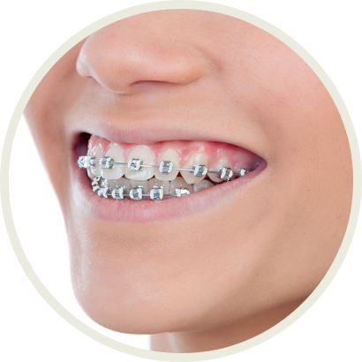 cj cee add bj braces image