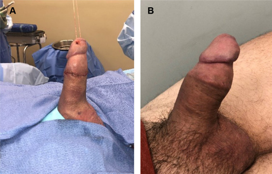 assem ramadan add penile implant porn photo