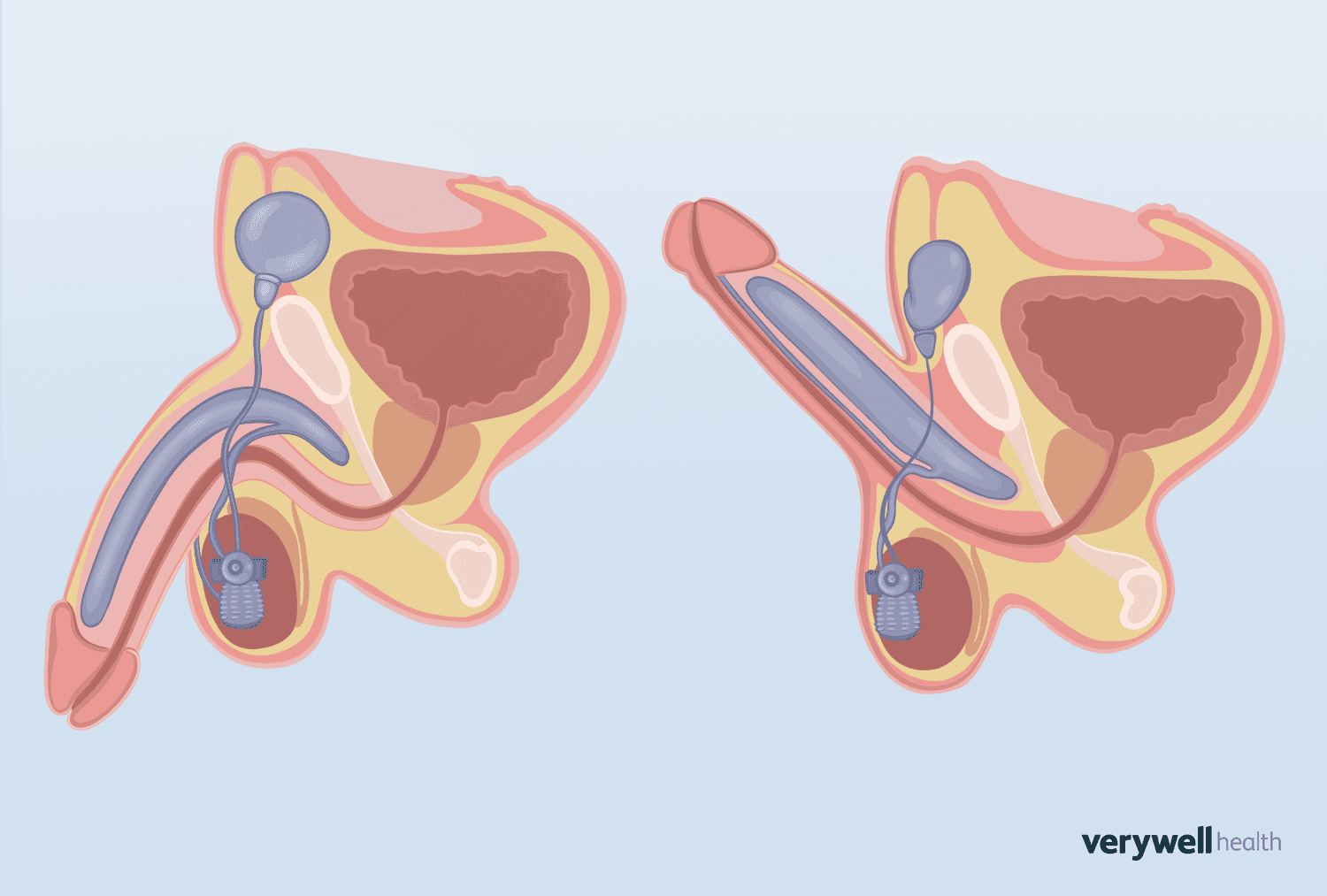 arsalan amjid add penile implant porn photo